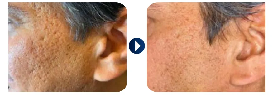 acne-scars