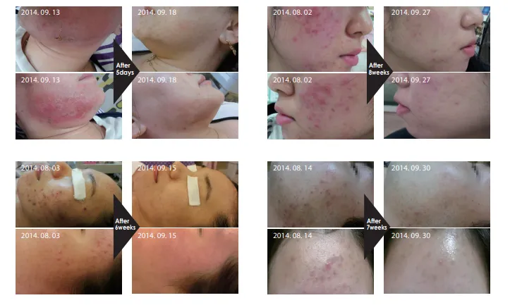 acne-scars