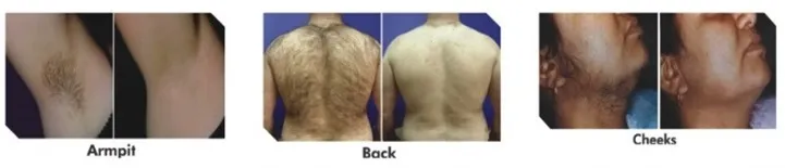 epitrio-pre-post