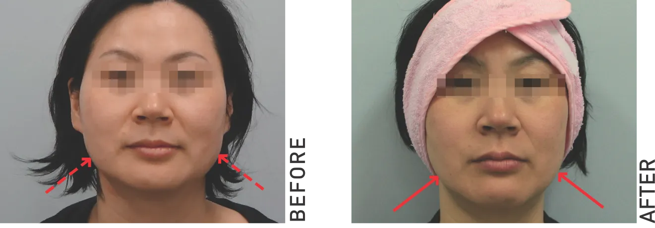 face-lifting