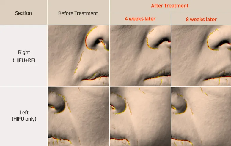 improvement-in-smile-lines