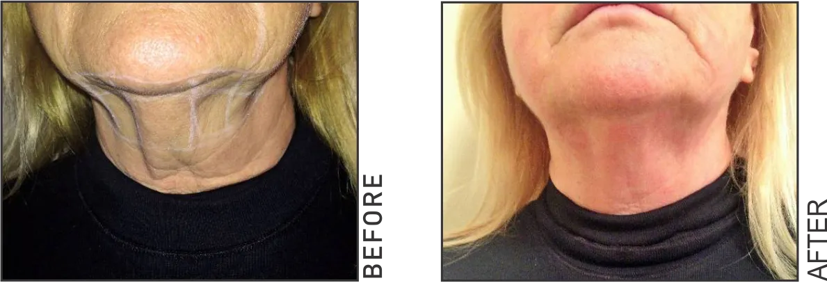 skin-laxity
