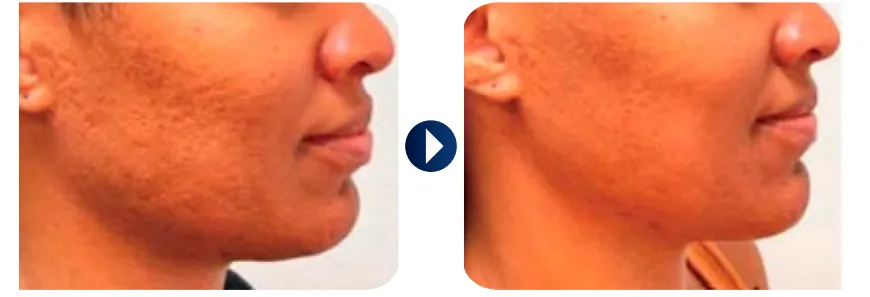 skin-regeneration